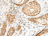 Immunohistochemistry of paraffin-embedded Human esophagus cancer tissue using ELF3 Polyclonal Antibody at dilution of 1:95(×200)