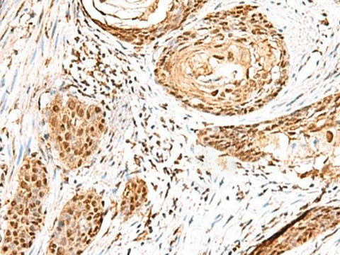 Immunohistochemistry of paraffin-embedded Human esophagus cancer tissue using ELF3 Polyclonal Antibody at dilution of 1:95(×200)