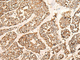 Immunohistochemistry of paraffin-embedded Human esophagus cancer tissue using GRIA4 Polyclonal Antibody at dilution of 1:40(×200)