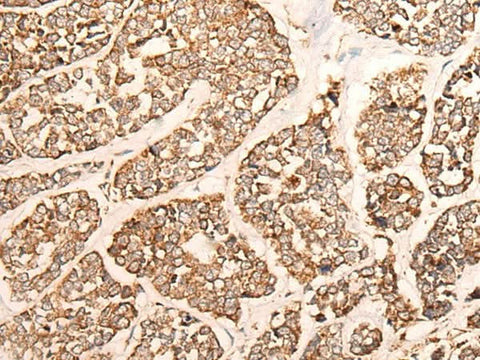 Immunohistochemistry of paraffin-embedded Human esophagus cancer tissue using GRIA4 Polyclonal Antibody at dilution of 1:40(×200)