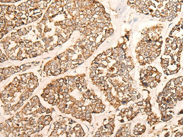 Immunohistochemistry of paraffin-embedded Human esophagus cancer tissue using GRIA4 Polyclonal Antibody at dilution of 1:40(×200)