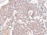 Immunohistochemistry of paraffin-embedded Human lung cancer tissue using JDP2 Polyclonal Antibody at dilution of 1:40(×200)
