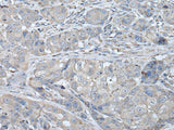 Immunohistochemistry of paraffin-embedded Human breast cancer tissue using RASA1 Polyclonal Antibody at dilution of 1:40(×200)