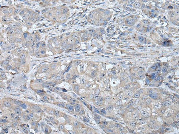 Immunohistochemistry of paraffin-embedded Human breast cancer tissue using RASA1 Polyclonal Antibody at dilution of 1:40(×200)