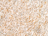 Immunohistochemistry of paraffin-embedded Human gastric cancer tissue using SREBF2 Polyclonal Antibody at dilution of 1:50(×200)