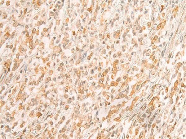 Immunohistochemistry of paraffin-embedded Human gastric cancer tissue using SREBF2 Polyclonal Antibody at dilution of 1:50(×200)