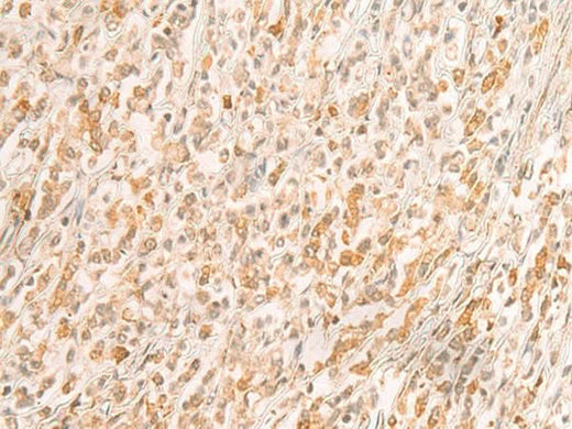 Immunohistochemistry of paraffin-embedded Human gastric cancer tissue using SREBF2 Polyclonal Antibody at dilution of 1:50(×200)