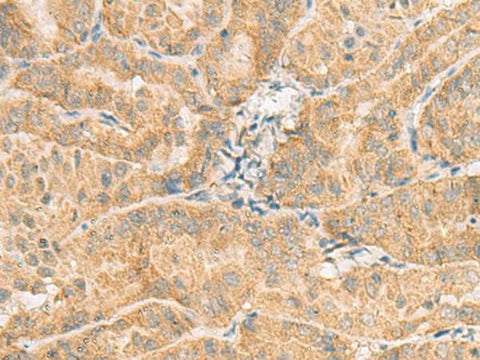 Immunohistochemistry of paraffin-embedded Human thyroid cancer tissue using NCOA4 Polyclonal Antibody at dilution of 1:130(×200)
