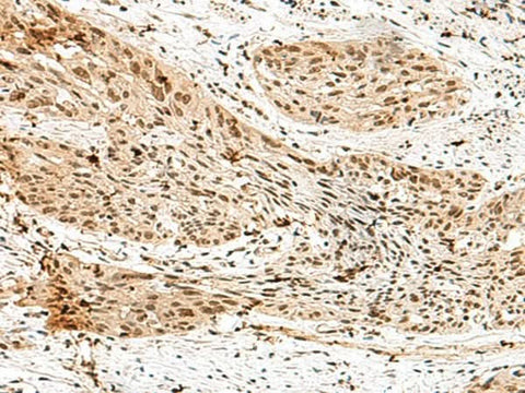 Immunohistochemistry of paraffin-embedded Human esophagus cancer tissue using RBM15 Polyclonal Antibody at dilution of 1:70(×200)