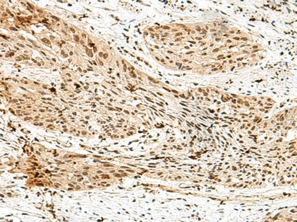 Immunohistochemistry of paraffin-embedded Human esophagus cancer tissue using RBM15 Polyclonal Antibody at dilution of 1:70(×200)