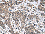 Immunohistochemistry of paraffin-embedded Human colorectal cancer tissue using MBL2 Polyclonal Antibody at dilution of 1:25(×200)