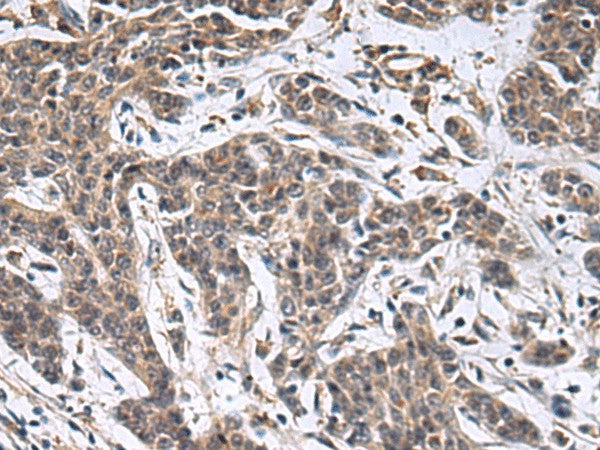 Immunohistochemistry of paraffin-embedded Human colorectal cancer tissue using MBL2 Polyclonal Antibody at dilution of 1:25(×200)