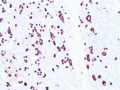 Promab 50001 ACTH antibody immunohistochemistry in pituitary adenoma; manufacturer figure