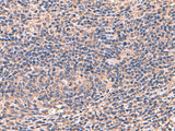 Immunohistochemistry of paraffin-embedded Human cervical cancer tissue using AHCYL1 Polyclonal Antibody at dilution of 1:70(×200)