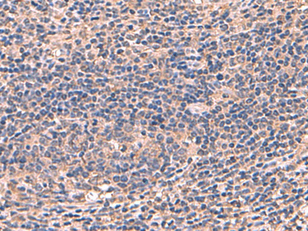 Immunohistochemistry of paraffin-embedded Human cervical cancer tissue using AHCYL1 Polyclonal Antibody at dilution of 1:70(×200)