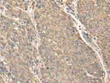 Immunohistochemistry of paraffin-embedded Human liver cancer tissue using C17orf67 Polyclonal Antibody at dilution of 1:50(×200)