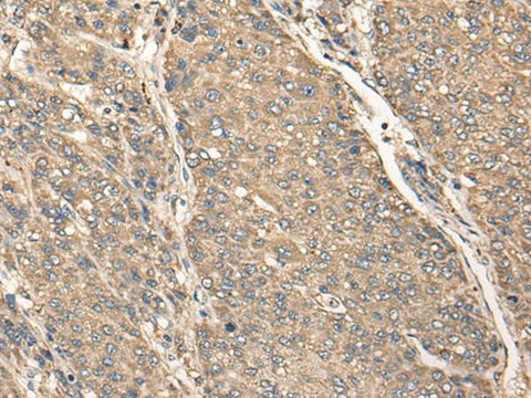 Immunohistochemistry of paraffin-embedded Human liver cancer tissue using C17orf67 Polyclonal Antibody at dilution of 1:50(×200)
