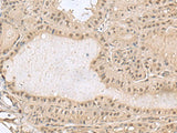 Immunohistochemistry of paraffin-embedded Human thyroid cancer tissue using PCLAF Polyclonal Antibody at dilution of 1:50(×200)