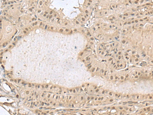 Immunohistochemistry of paraffin-embedded Human thyroid cancer tissue using PCLAF Polyclonal Antibody at dilution of 1:50(×200)