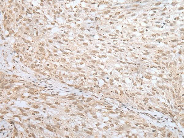 Immunohistochemistry of paraffin-embedded Human lung cancer tissue using MORF4L1 Polyclonal Antibody at dilution of 1:45(×200)