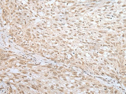 Immunohistochemistry of paraffin-embedded Human lung cancer tissue using MORF4L1 Polyclonal Antibody at dilution of 1:45(×200)