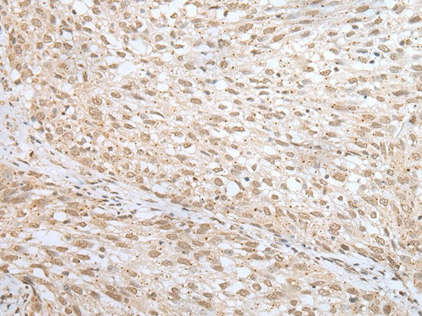 Immunohistochemistry of paraffin-embedded Human lung cancer tissue using MORF4L1 Polyclonal Antibody at dilution of 1:45(×200)