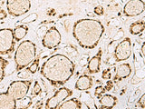 Immunohistochemistry of paraffin-embedded Human thyroid cancer tissue using XRCC4 Polyclonal Antibody at dilution of 1:60(×200)
