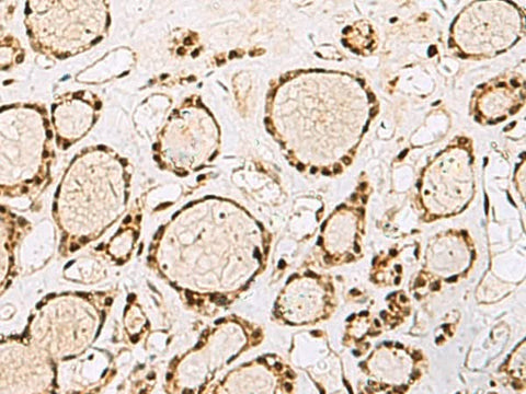 Immunohistochemistry of paraffin-embedded Human thyroid cancer tissue using XRCC4 Polyclonal Antibody at dilution of 1:60(×200)