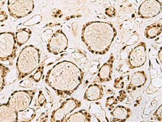 Immunohistochemistry of paraffin-embedded Human thyroid cancer tissue using XRCC4 Polyclonal Antibody at dilution of 1:60(×200)