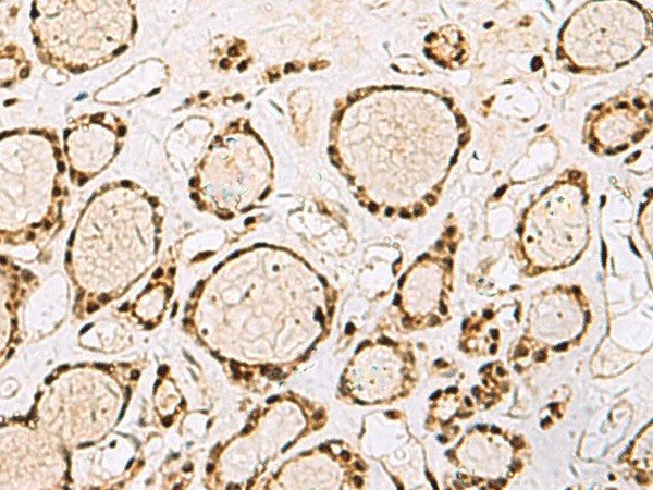 Immunohistochemistry of paraffin-embedded Human thyroid cancer tissue using XRCC4 Polyclonal Antibody at dilution of 1:60(×200)