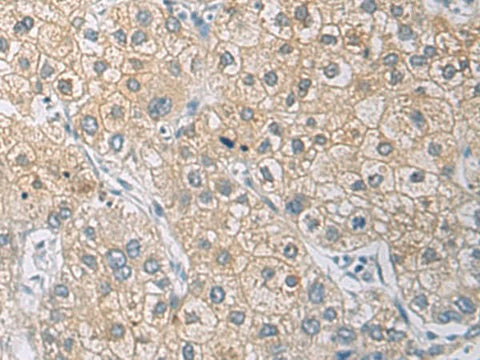 Immunohistochemistry of paraffin-embedded Human liver cancer tissue using IL1RN Polyclonal Antibody at dilution of 1:50(×200)