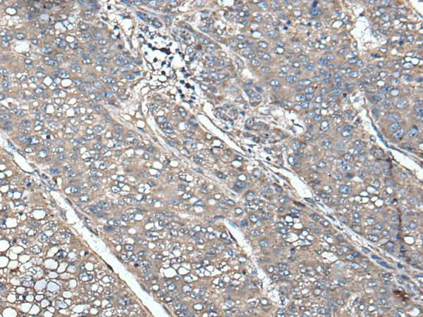 Immunohistochemistry of paraffin-embedded Human liver cancer tissue using UNC13B Polyclonal Antibody at dilution of 1:85(×200)