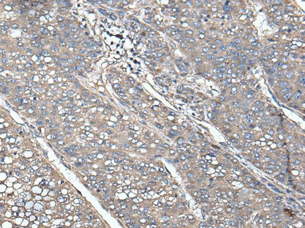 Immunohistochemistry of paraffin-embedded Human liver cancer tissue using UNC13B Polyclonal Antibody at dilution of 1:85(×200)