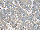 Immunohistochemistry of paraffin-embedded Human liver cancer tissue using TNF Polyclonal Antibody at dilution of 1:40(×200)