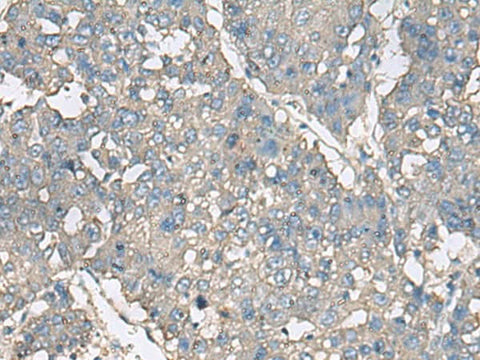 Immunohistochemistry of paraffin-embedded Human liver cancer tissue using TNF Polyclonal Antibody at dilution of 1:40(×200)