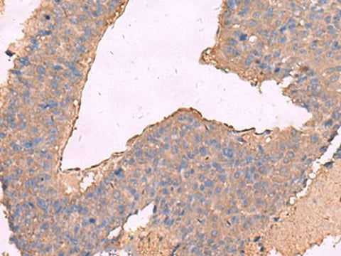 Immunohistochemistry of paraffin-embedded Human liver cancer tissue using KCNN2 Polyclonal Antibody at dilution of 1:65(×200)