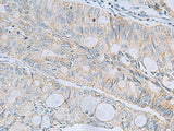 Immunohistochemistry of paraffin-embedded Human colorectal cancer tissue using MSI2 Polyclonal Antibody at dilution of 1:60(×200)