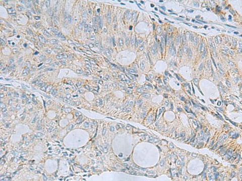 Immunohistochemistry of paraffin-embedded Human colorectal cancer tissue using MSI2 Polyclonal Antibody at dilution of 1:60(×200)