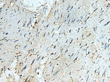 Immunohistochemistry of paraffin-embedded Human gastric cancer tissue using RAPSN Polyclonal Antibody at dilution of 1:40(×200)