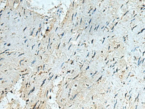 Immunohistochemistry of paraffin-embedded Human gastric cancer tissue using RAPSN Polyclonal Antibody at dilution of 1:40(×200)