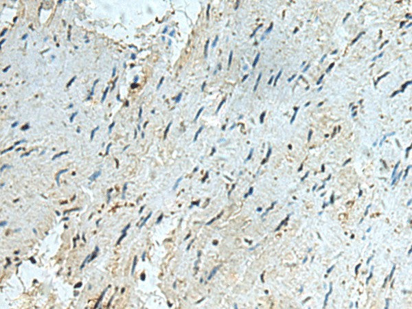 Immunohistochemistry of paraffin-embedded Human gastric cancer tissue using RAPSN Polyclonal Antibody at dilution of 1:40(×200)