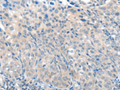Immunohistochemistry of paraffin-embedded Human cervical cancer tissue using SLC17A6 Polyclonal Antibody at dilution of 1:100(×200)