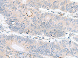 Immunohistochemistry of paraffin-embedded Human colorectal cancer tissue using PDE6D Polyclonal Antibody at dilution of 1:60(×200)