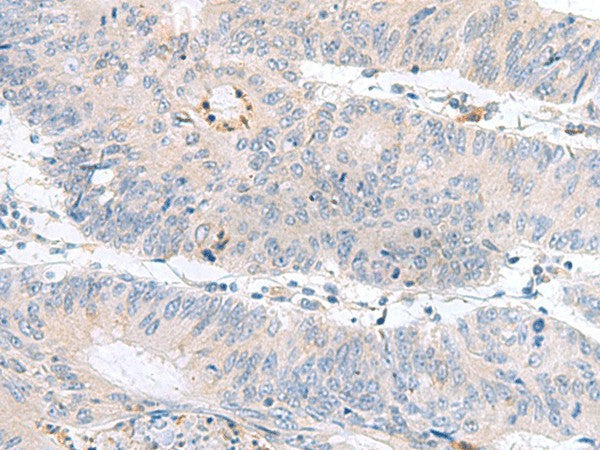 Immunohistochemistry of paraffin-embedded Human colorectal cancer tissue using PDE6D Polyclonal Antibody at dilution of 1:60(×200)