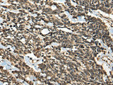 Immunohistochemistry of paraffin-embedded Human lung cancer tissue using MICU1 Polyclonal Antibody at dilution of 1:35(×200)