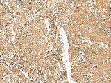 Immunohistochemistry of paraffin-embedded Human cervical cancer tissue using GOLGA6A Polyclonal Antibody at dilution of 1:50(×200)