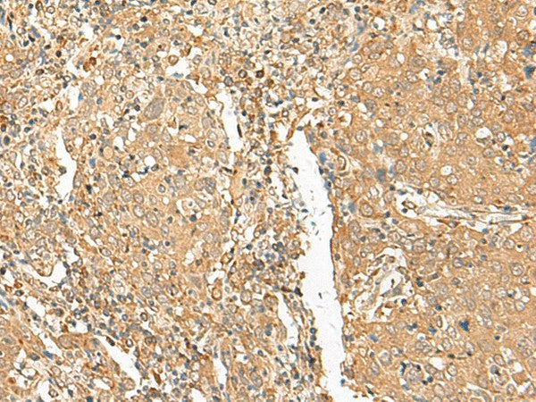 Immunohistochemistry of paraffin-embedded Human cervical cancer tissue using GOLGA6A Polyclonal Antibody at dilution of 1:50(×200)