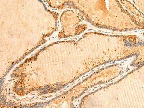 Immunohistochemistry of paraffin-embedded Human thyroid cancer tissue using PPM1B Polyclonal Antibody at dilution of 1:50(×200)