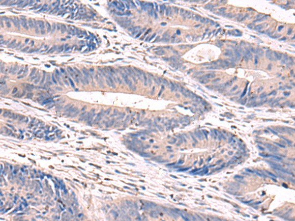 Immunohistochemistry of paraffin-embedded Human colorectal cancer tissue using GKAP1 Polyclonal Antibody at dilution of 1:100(×200)