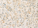 Immunohistochemistry of paraffin-embedded Human liver cancer tissue using F11R Polyclonal Antibody at dilution of 1:40(×200)